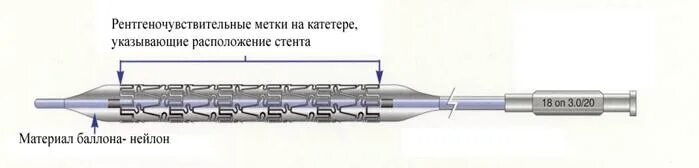 Система доставки стенты. Стентоник коронарные стенты. Система доставки стента. Наконечник системы доставки стента. Длина системы доставки стента.