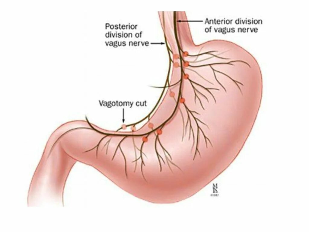 Нерв пищевода. Ваготомия желудка при язвенной болезни желудка. Ваготомия желудка при язвенной болезни. Селективная ваготомия желудка. Стволовая ваготомия при язвенной болезни желудка.
