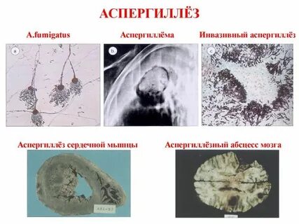 Аспергиллез легких