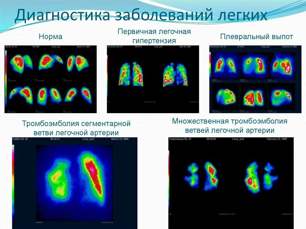 Диагноз легкое расстройство. Радиоизотопные (радионуклидные) исследования. Сцинтиграфия Тэла. Сцинтиграфия легких при Тэла. Тэла на сцинтиграфии.