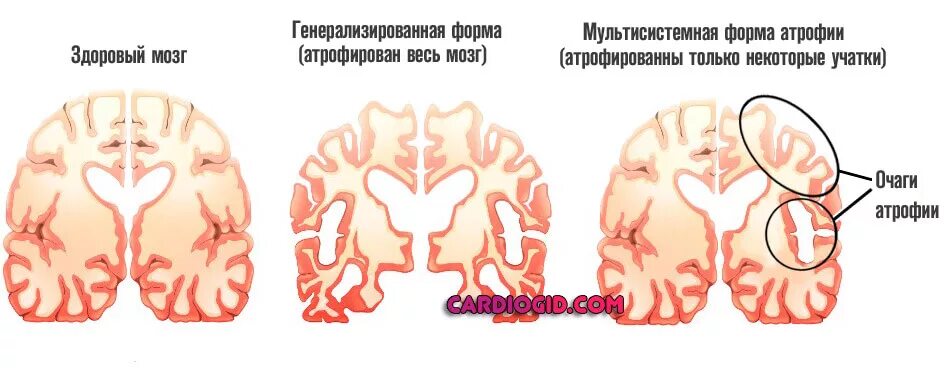 Степени атрофия мозга