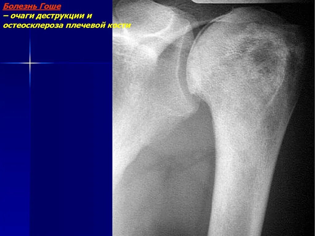 Очаговые изменения костей. Деструкция бедренной кости рентген. Остеосклероз плечевой кости на рентгене. Остеосклероз плечевого сустава на рентгене. Остеохондрома плечевой кости.