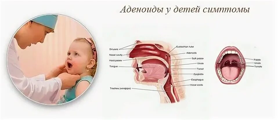 Аденоиды у детей симптомы. Аденоиды у детей симпто.