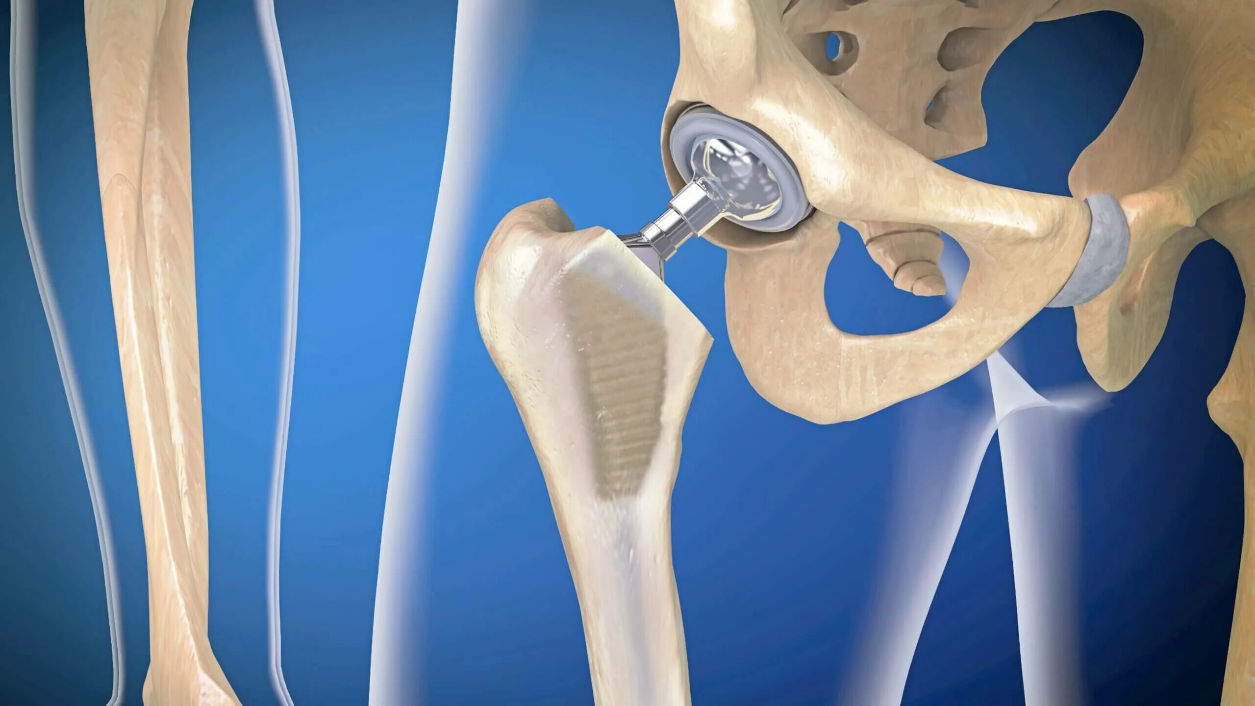 Мрт после эндопротезирования. Гибридный эндопротез тазобедренного сустава. Эндопротезирование тазобедренного сустава 3 д. Титановый тазобедренный эндопротез. Имплант тазобедренного сустава Титан.