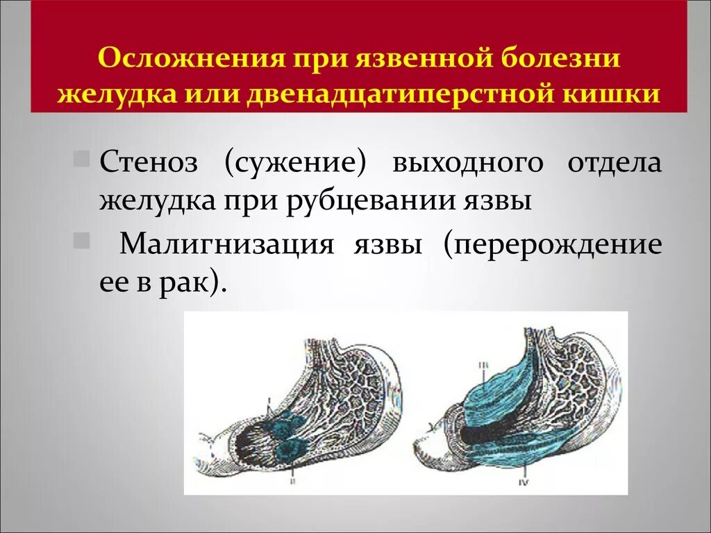 Осложненная язвенная болезнь желудка и двенадцатиперстной кишки. Осложнения язвенной болезни желудка. Осложнения язвенной болезни желудка и двенадцатиперстной кишки. Осложнения язвенной болезни желудка и двенадцатиперстной. Осложнения желудка 12 перстной кишки