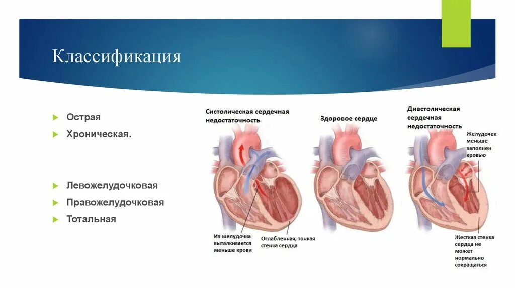 Ибс хроническая сердечная недостаточность. Острая хроническая сердечная недостаточность классификация. Острая правожелудочковая недостаточность классификация. Левожелудочковая недостаточность классификация. ХСН левожелудочковая недостаточность.