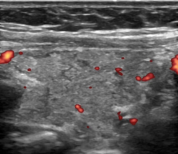 Перинодулярный кровоток что это. Узел в щитовидной железе на УЗИ. Лазерная коагуляция кисты щитовидной железы. Щитовидная железа узелок на УЗИ. Доброкачественный узел щитовидной железы.