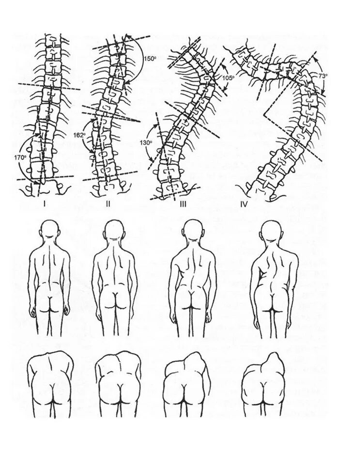 Искривление позвоночника градусы. S образный сколиоз позвоночника 2 степени. Сколиоз 2 степени s образный идиопатический. Сколиоз 2 степени угол искривления. Сколиотическая деформации позвоночника 1-2 степени.