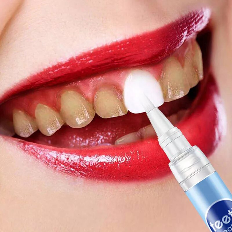 Отбеливание полости рта. Professional Whitening Kit отбеливание. Ручка для отбеливания зубов. Стоматологическое отбеливание. Отбеливание зубов в стоматологии.