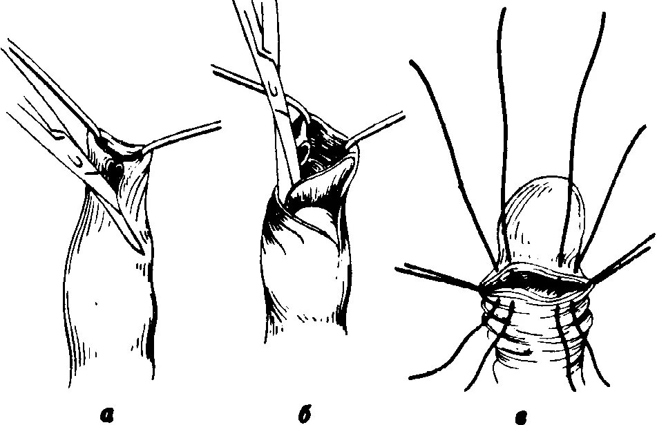 Головка у мужчин. Операции при фимозе и парафимозе. Операция обрезание при фимозе. Операция циркумцизио фимоз. Операция при фимозе схема.