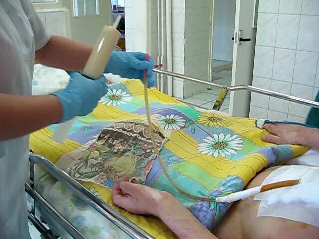 Гастростома для энтерального питания. Кормить через стому. Кормление тяжелобольного пациента через гастростому. Питание через гастростому показания. Показания для кормления через гастростому.