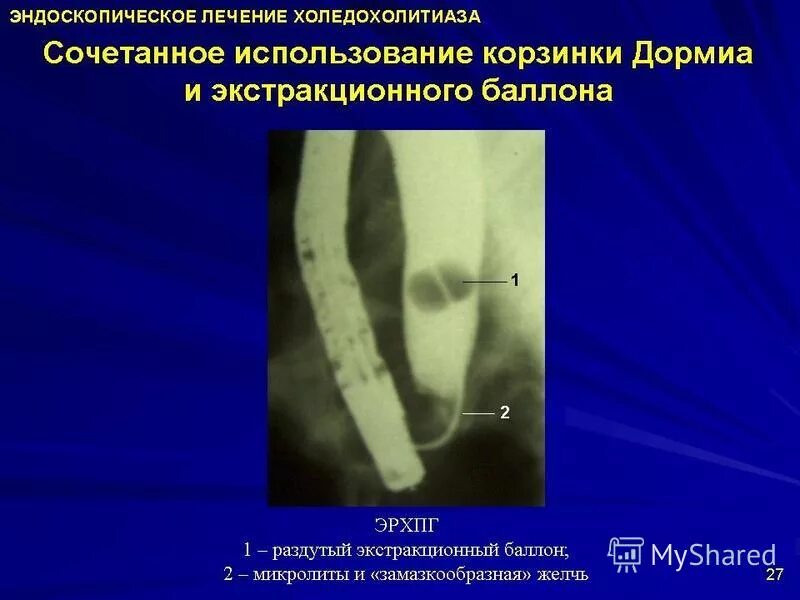 холедохоэктазия