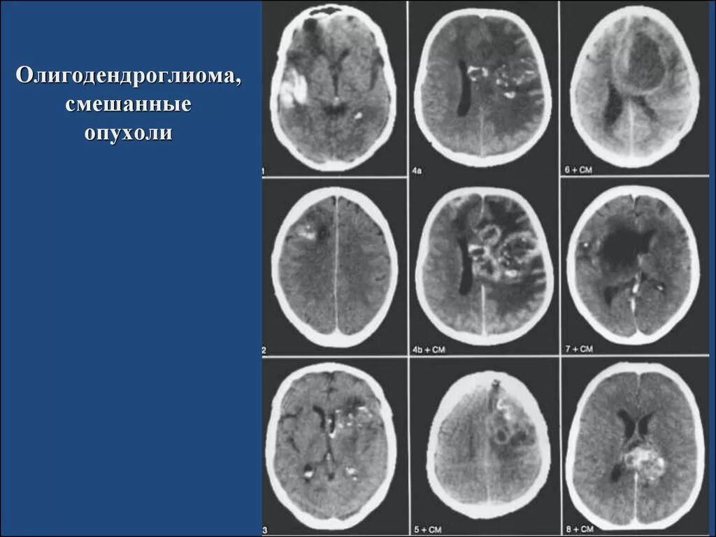 Опухоли теменной. Анапластическая олигодендроглиома. Олигодендроглиома гистология. Олигодендроглиома головного мозга кт.