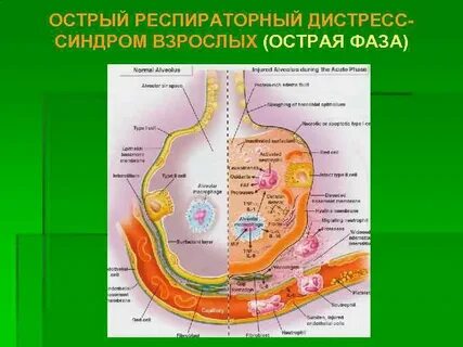 Острый респираторный дистресс