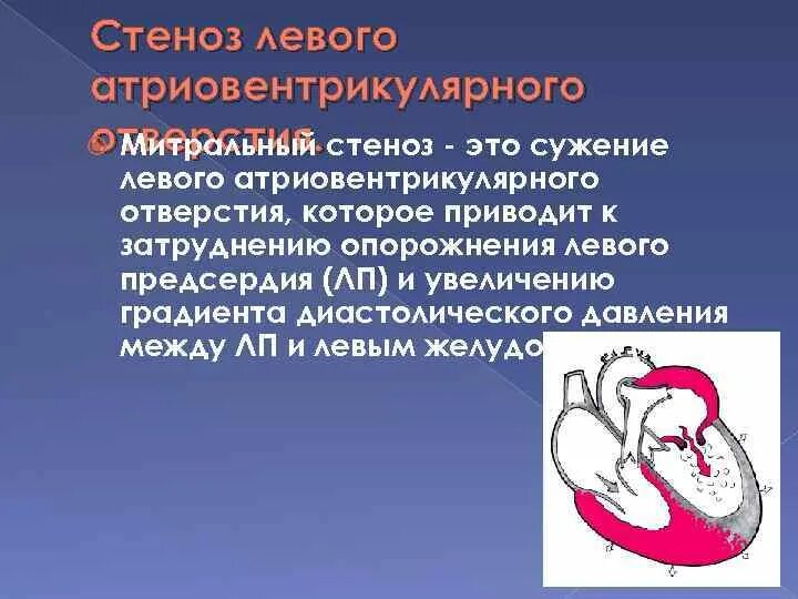 Порок сердца стеноз аортального клапана. Изолированный стеноз аорты. Стеноз левой. Стеноз левой. Стеноз огибающей артерии.
