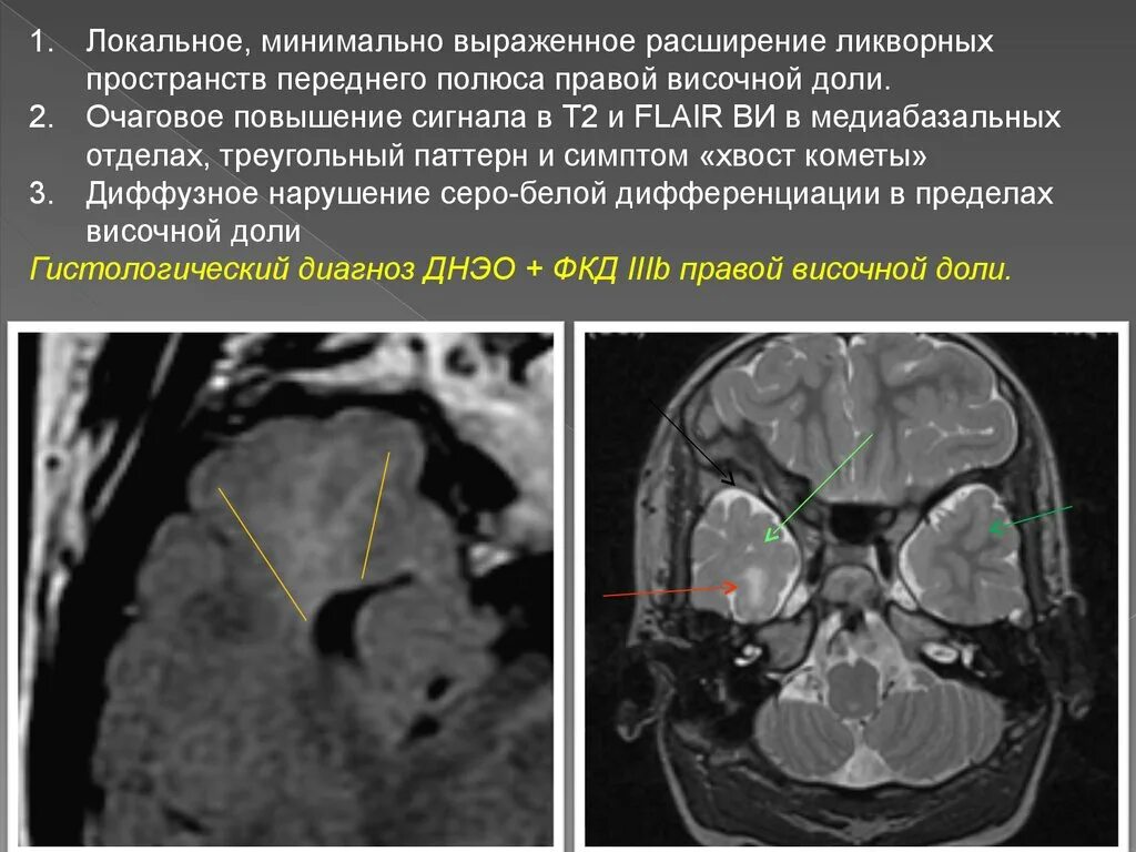 Расширенные ликворные пространства