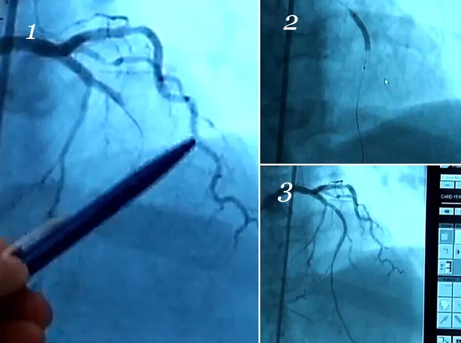 Стентирование сосудов последствия. Операция стентирование. Операция стентирования сосудов сердца. Операция на сердце коронарография и стентирование. Тенцирование операция.