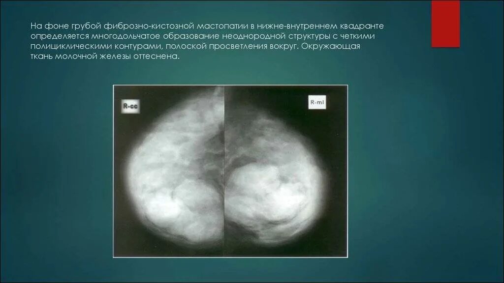 Признаки фиброзных изменений молочных. Узловая форма ФКМ молочной железы маммография. Маммография фиброзно кистозная мастопатия снимки. Фиброзная мастопатия маммограмма. Диффузная мастопатия молочной железы рентген.
