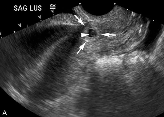 Плод в полости матки. Внематочная Трубная беременность УЗИ. УЗИ при трубной внематочной беременности. Разрыв маточной трубы на УЗИ. Шеечная беременность УЗИ.