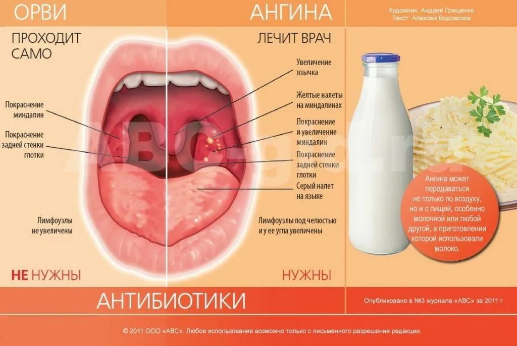 Сильно болит горло антибиотик. Вирусная и бактериальная ангина.