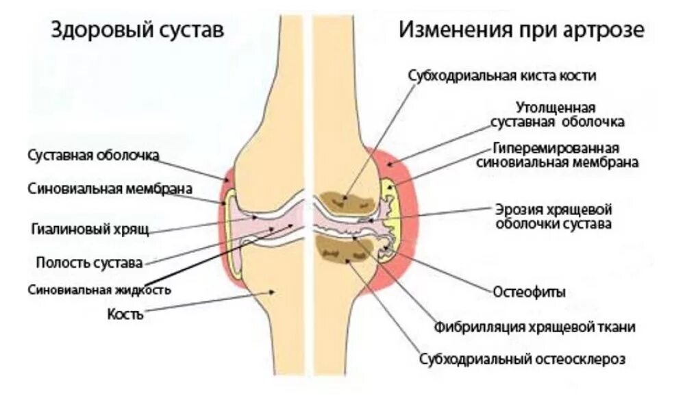 Деформирующий артроз коленного сустава схема. Синовиальная суставная жидкость вырабатывается. Строение синовиального сустава. Посттравматический коксартроз тазобедренного сустава. Истончены суставные хрящи.