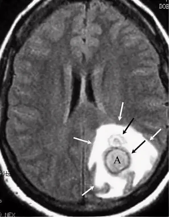 Туберкулез головного. Туберкулема головного мозга. Туберкулема головного мозга мрт. Туберкулез головного мозга мрт.