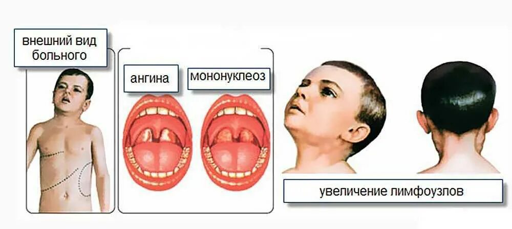 Инфекционный мононуклеоз. Поражение ротоглотки инфекционный мононуклеоз. Внешние проявления мононуклеоза.