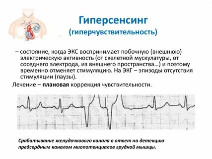 Режимы экг