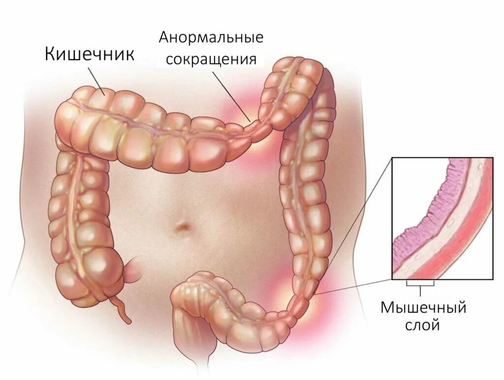 Синдром раздражения Толстого кишечника. Синдром раздраженного кишечника (СРК) симптомы. Синдром раздражённого кишечника (СРК). Синдром раздраженного кишечника толстой кишки симптомы. Ленивый кишечник симптомы и лечение