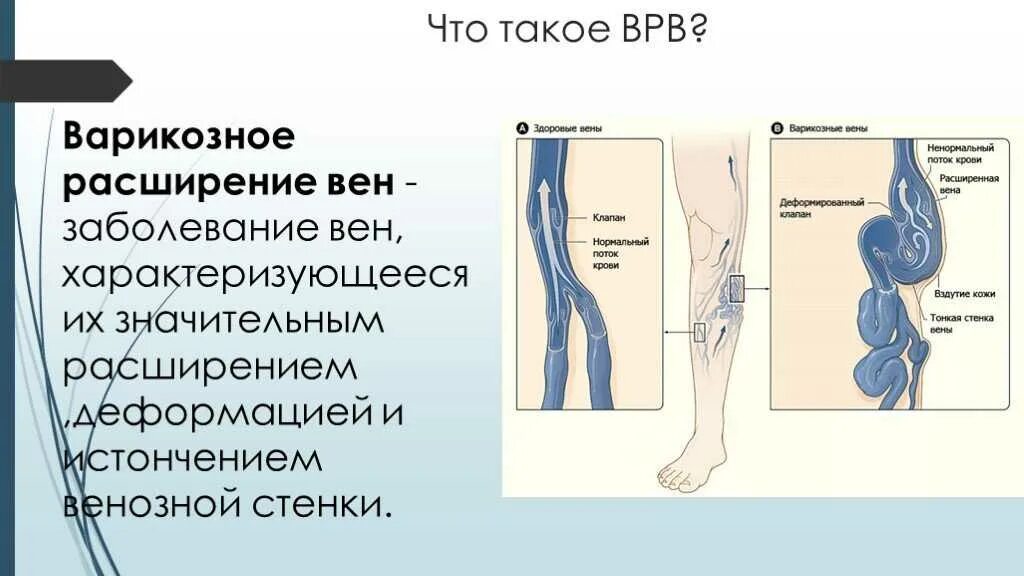 Варикоз малого таза причины. Варикозное расширение вен. Варикозное расширение вен малого таза. Варикозное расширение вен органов малого таза. Варикозное расширение вен таза у женщин.