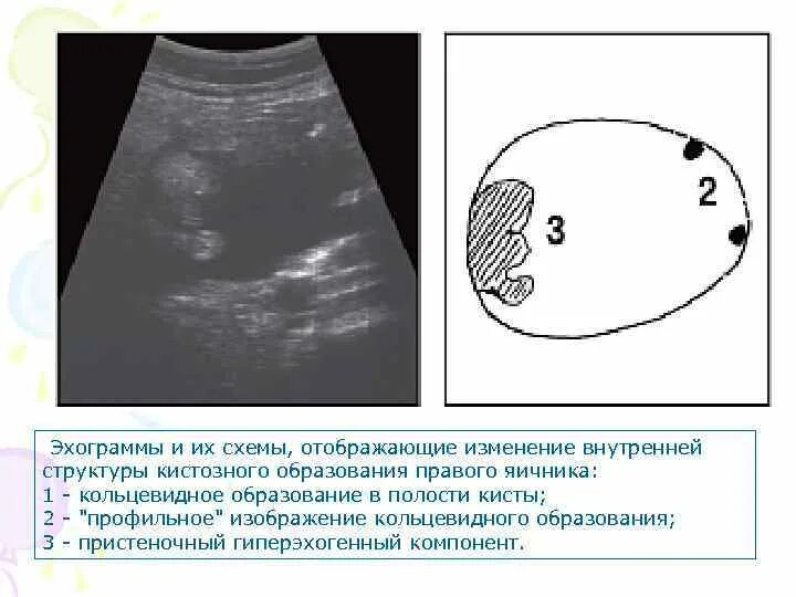 Киста яичника с пристеночным компонентом. Пристеночный компонент на УЗИ. Гиперэхогенные структуры на УЗИ. Гиперэхогенный пристеночный компонент.