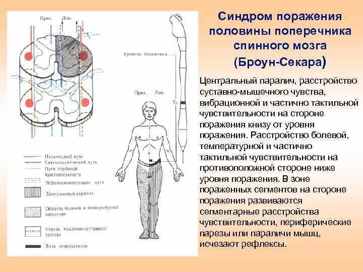 Методы исследования синдрома Броун Секара. Поражения половины поперечника спинного мозга (синдром Броун-Секара). Синдром Броун Секара периферический паралич. Синдром поражения передних и задних Корешков спинного мозга.