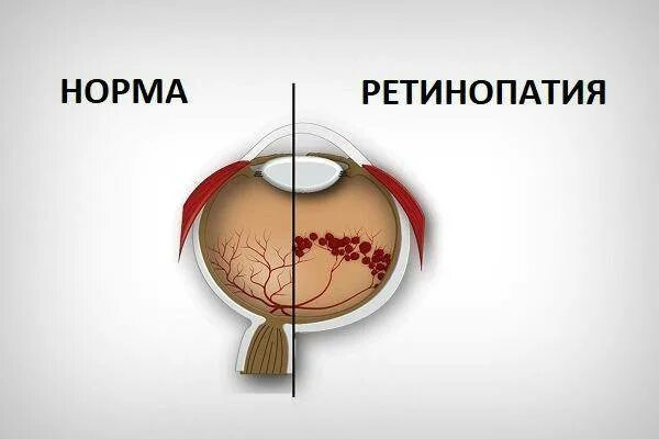 Операция ретинопатии. Осложнения ретинопатии недоношенных. ретинопатия 1 степени у недоношенных детей. ретинопатии недоношенных 5 степени. ретинопатия 3 степени у недоношенных.