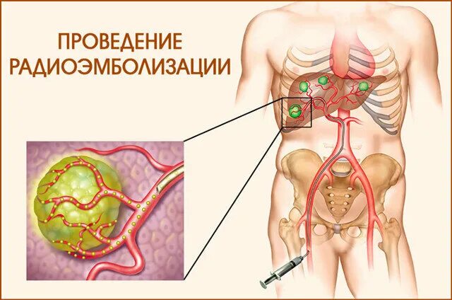 Радиоэмболизация печени. Химиоэмболизация опухоли печени. Метастазирование печени. Вылечить метастазы в печени