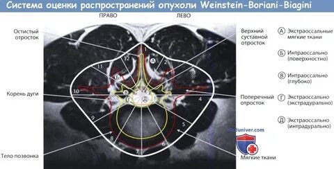 Распространение опухоли