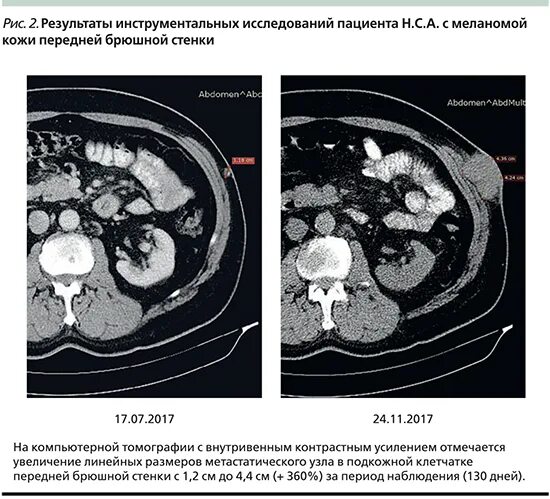 Кт передней брюшной стенки