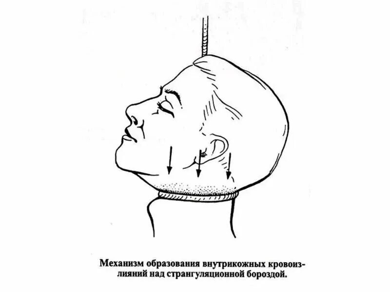 Повешение борозда. Странгуляционная борозда судебная медицина. странгуляционная борозда мозга. странгуляционная борозда при асфиксии. странгуляционная борозда механизм образования.