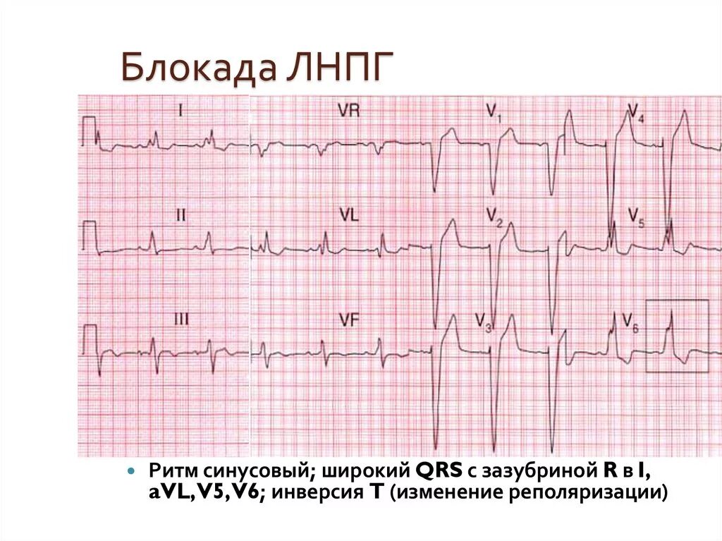 Блокада левой ножки пучка гиса на экг. Неполная блокада левой ножки пучка Гиса на ЭКГ.