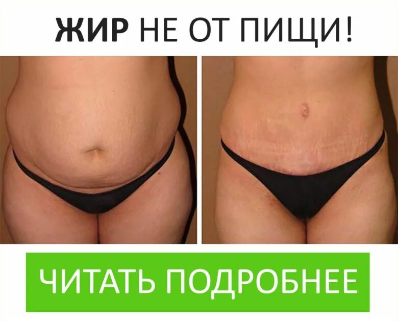 Liposonix (липосоникс). Липолитики живот до и после женщины отзывы. Живот сразу после липосакции. Липолитики против целлюлита. Липолитики в живот до и после.