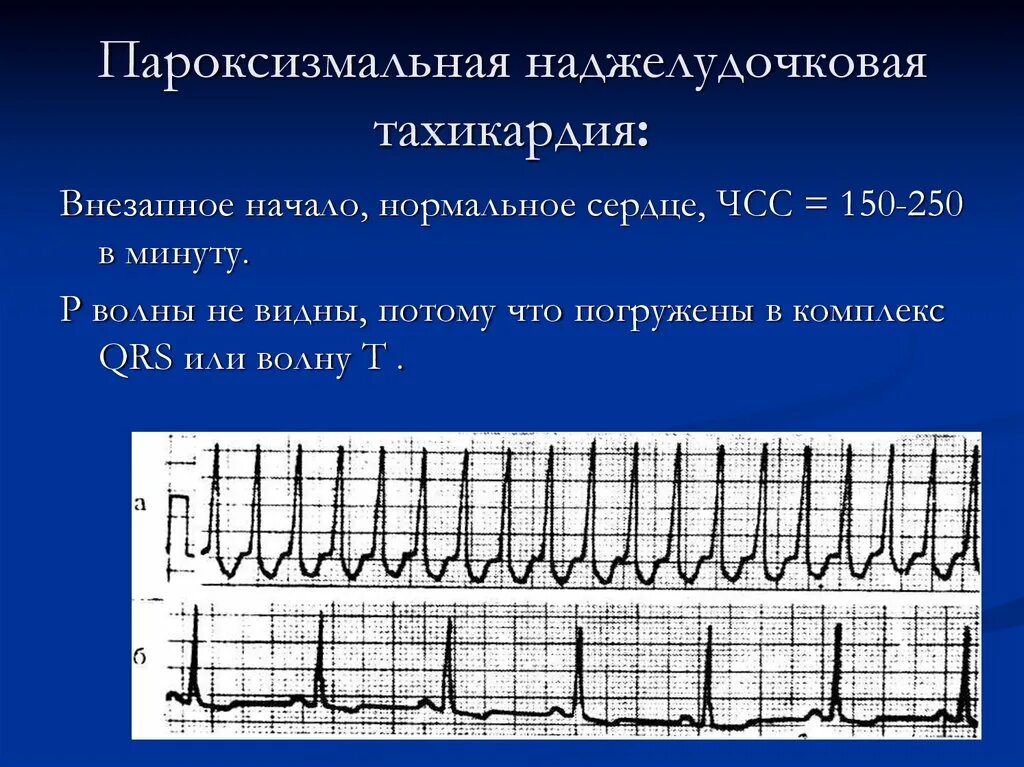 Фж юлчкжсл цхшлтптпшг шхчхс юлщвчл илшлтвь юпнж. Критерии наджелудочковой пароксизмальной тахикардии на ЭКГ. Пароксизмальная наджелудочковая тахикардия на хмэкн. Пароксизмальная тахикардия ЭКГ. ЭКГ при пароксизмальной наджелудочковой тахикардии.