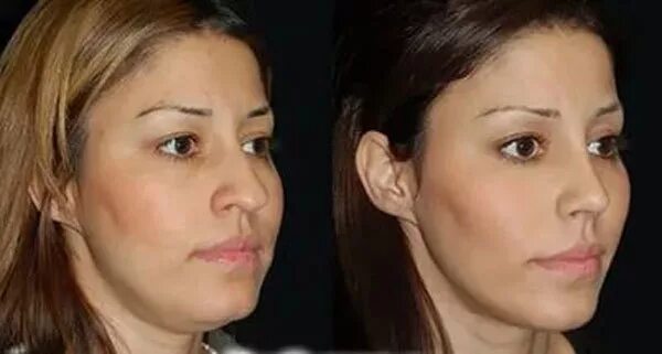 фиби тонкин комки биша. белла хадид до пластики. виктория бекхэм до и после. белла хадид пластика.