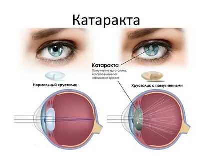 Почему в линзах мутно в глазах