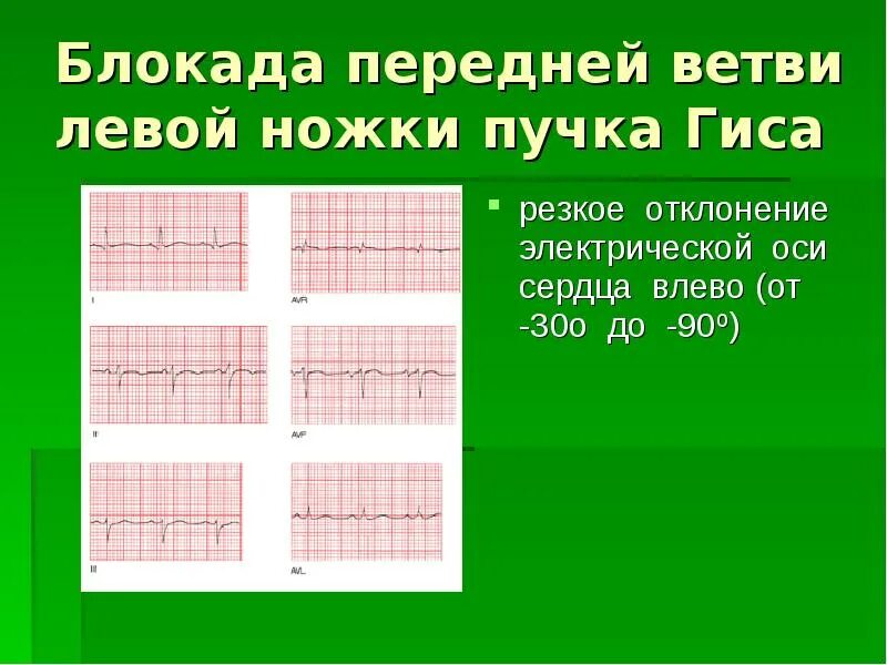 Блокада левой задней ножки. ЭКГ при блокаде передней ветви левой ножки пучка Гиса. Блокада передней ветви левой ножки пучка Гиса на ЭКГ. Отклонение ЭОС влево, блокада передней ветви левой ножки пучка Гиса;. Блокада передне-верхней ветви ЛНПГ.