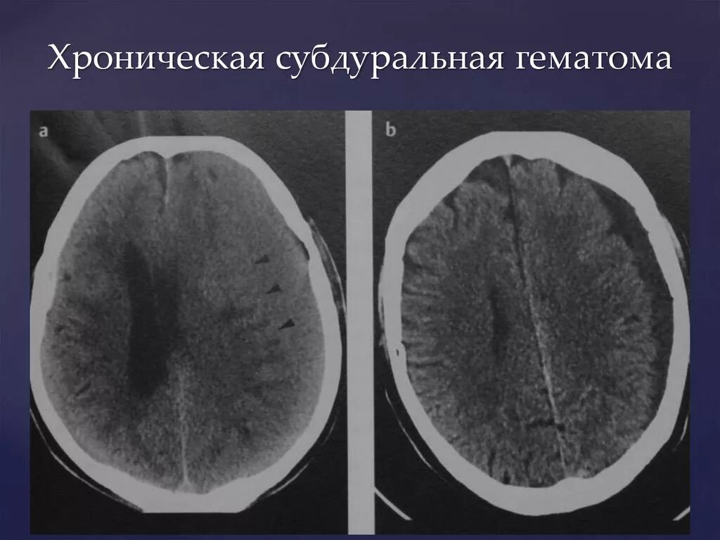 Субдуральная и эпидуральная гематома. Хроническая субдуральная гематома на кт. Подострая субдуральная гематома на кт. Субдуральная гематома на кт. Травматическое кровоизлияние