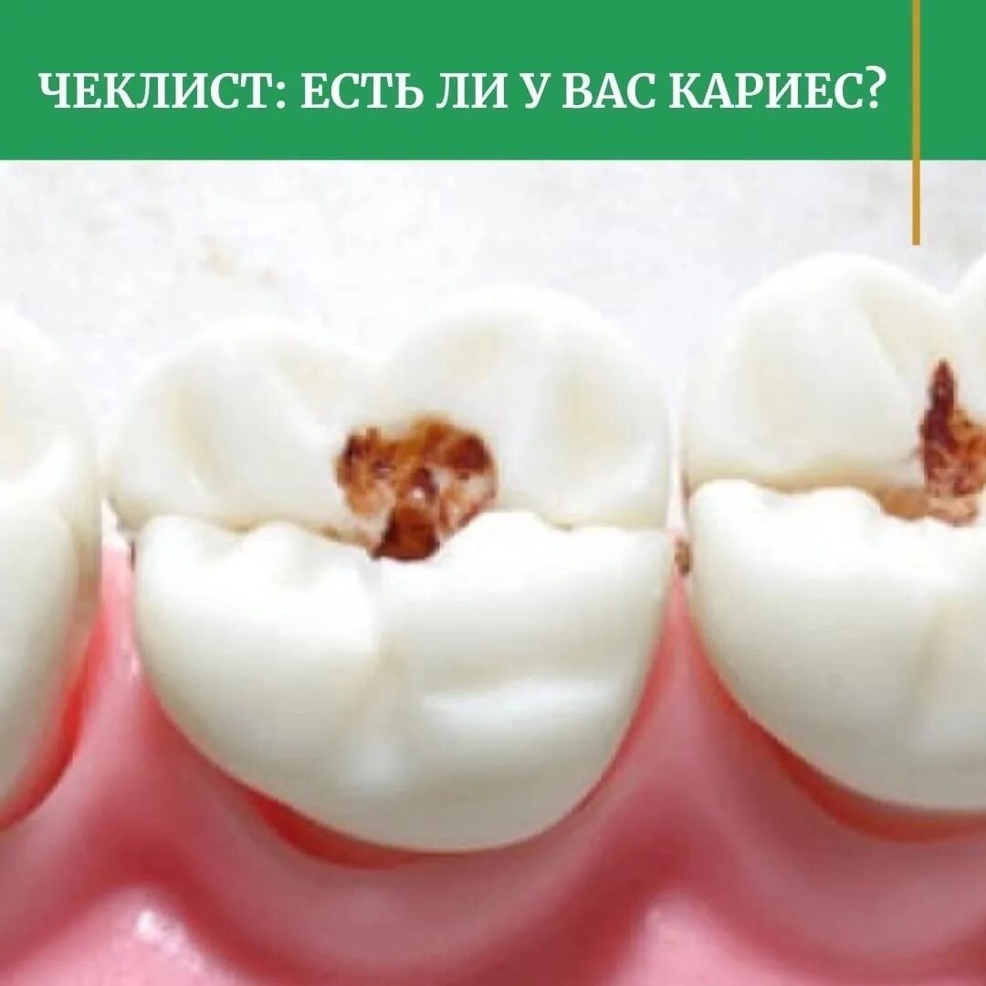 Кариес передается при поцелуе. Кариес передается при поцелуе