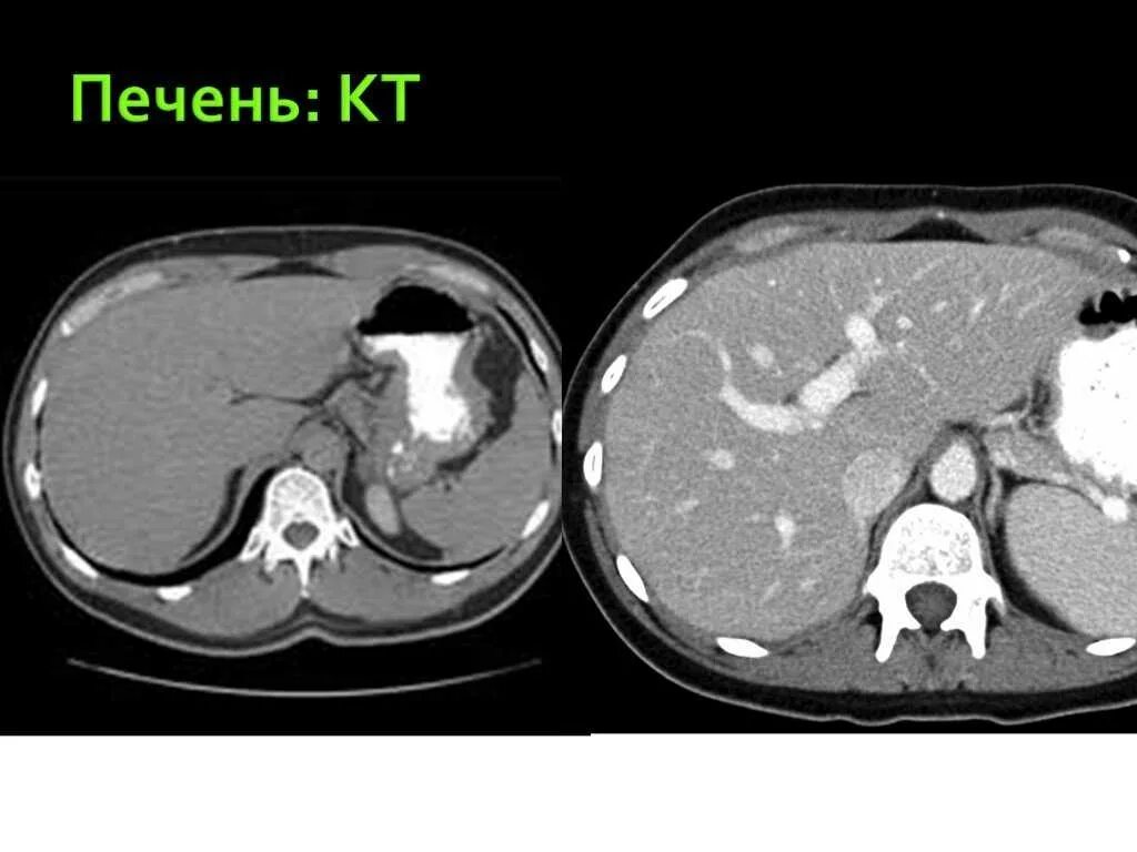 Фиброламеллярная карцинома печени кт. Метастатическое поражение печени мрт. Фокальная нодулярная гиперплазия печени на кт. Кт норма печень