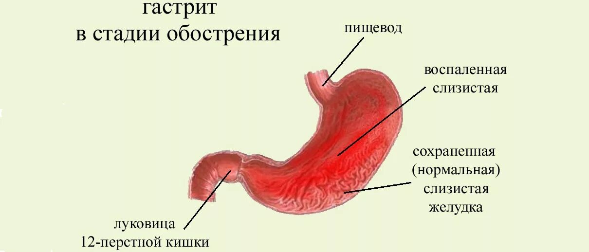 Пищевода 1 степени. Поверхностный дуоденит. Воспалительные заболевания слизистой оболочки желудка.