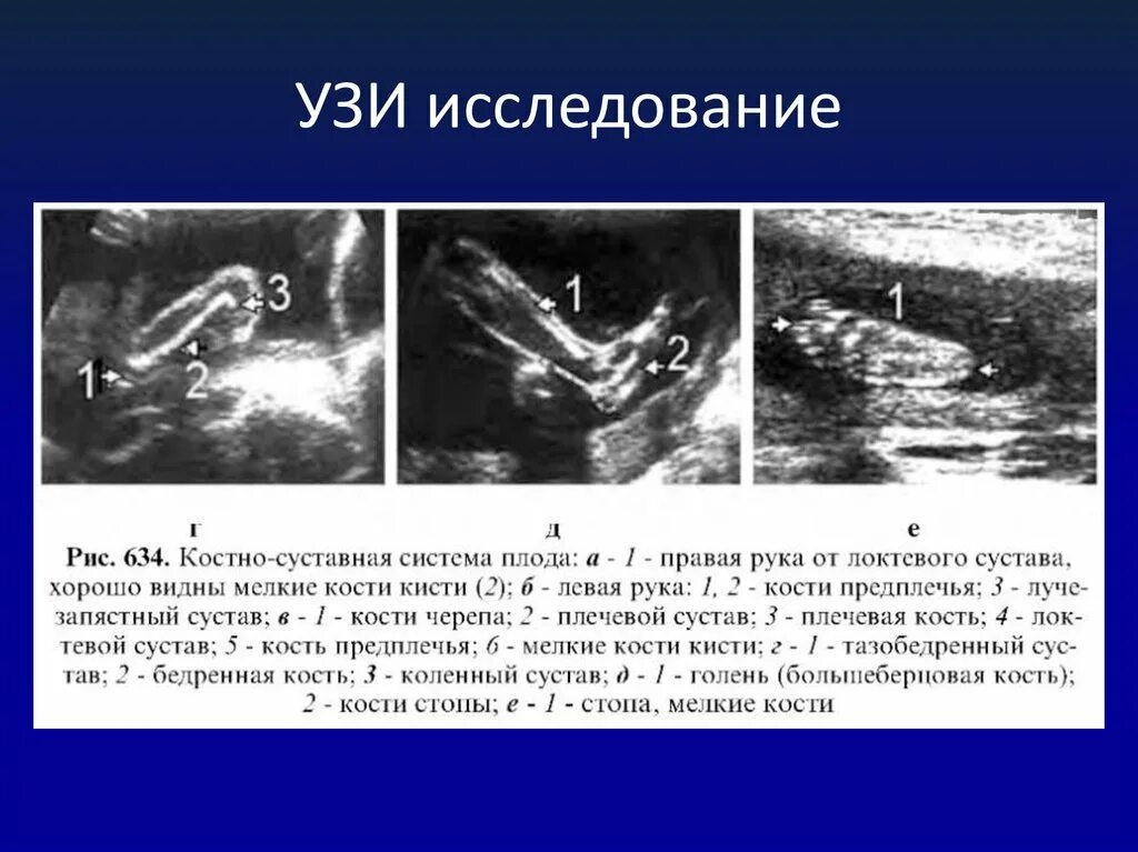 Укорочение трубчатых костей. УЗИ костно-суставной системы. Ультразвукового исследования костно-суставной системы. Ультразвуковое исследование костей.