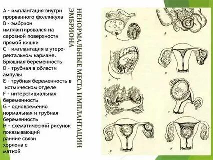 Внематочная беременность операция сколько