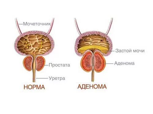 Предстательная железа здорового человека и больного.